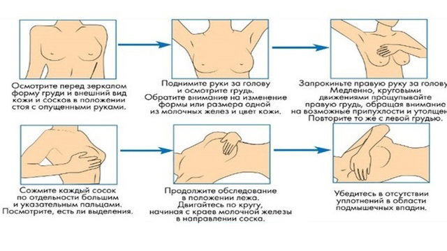 самообстеження молочних залоз