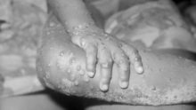Более 80 случаев уже в 14 странах: можно ли говорить о начале пандемии обезьяньей оспы оспа