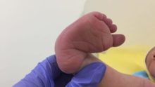 Клишоногість – складна деформація стопи. Як лікується клишоногість
