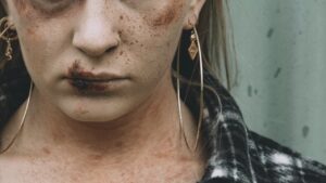 Как быстро убрать синяк на теле – объясняет врач