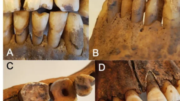 Кариес – древняя болезнь: ученые обнаружили, что у 62% викингов были проблемы с зубами