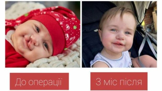закрили розщілину губи