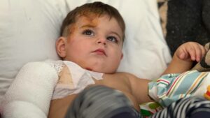 врятували дитину з глибокими опіками